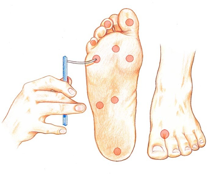 diabetic foot diabetic foot